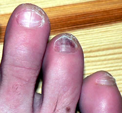 bruised toenail